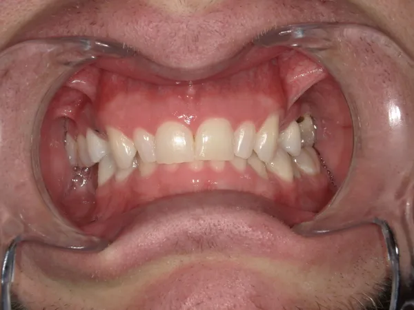 Before - Peg laterals restored to a more normal appearance with composite dental veneers in draper
