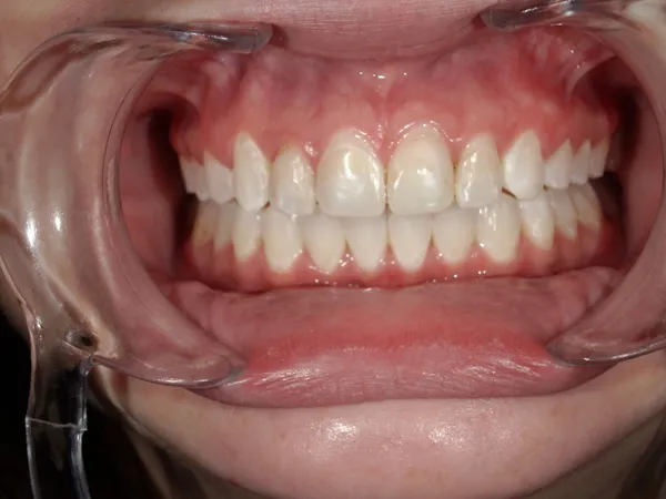 Before - Upper 6 dental crowns
