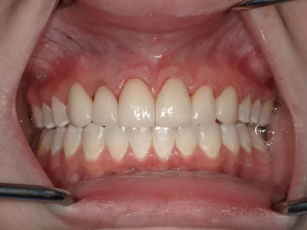 After - Upper 6 dental crowns