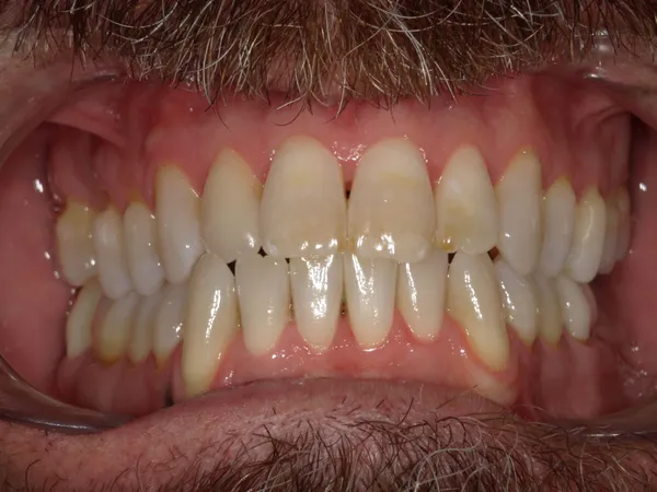 Before - Two-week teeth whitening treatment in draper, Utah with custom trays