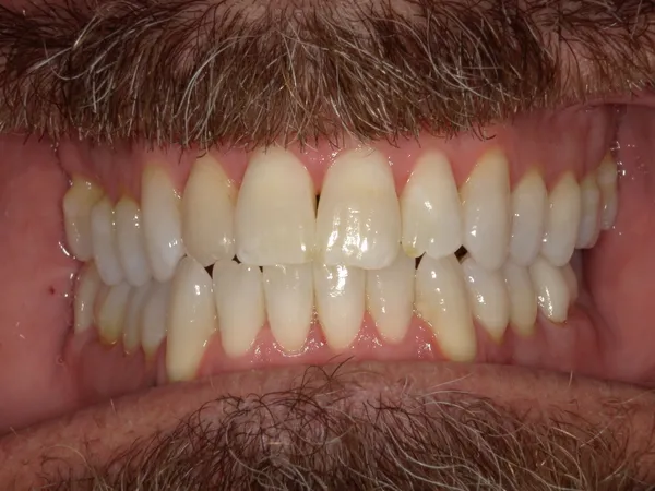 After - Two-week teeth whitening treatment in draper, Utah with custom trays