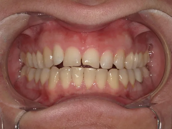 Before - Broken upper front teeth fixed with dental fillings
