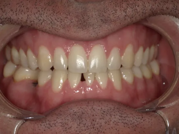 Before - Teeth whitening and lower bonding to close the spacing