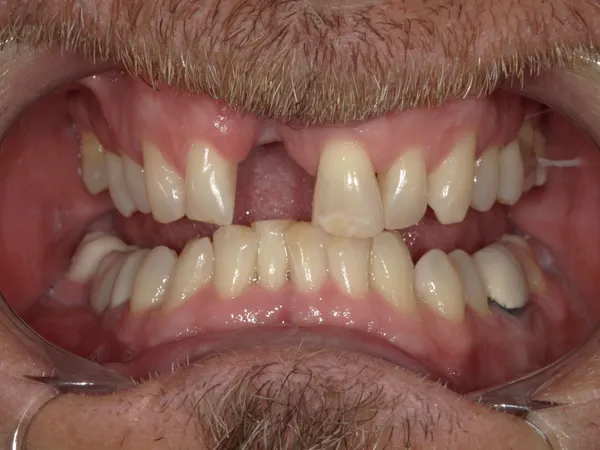 Before - Upper dental veneers and a bridge to replace a missing tooth