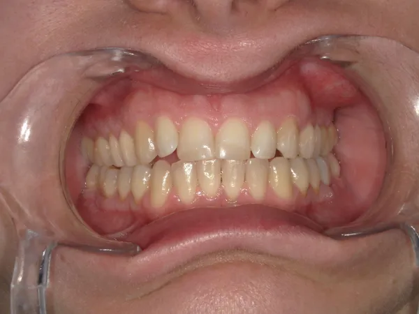 After - Broken upper front teeth fixed with dental fillings