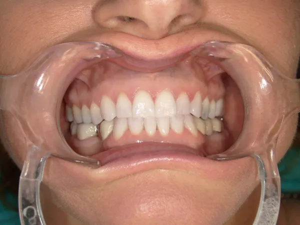 Before - Replaced lower crowns with metal free dental crowns and direct veneers on upper central teeth