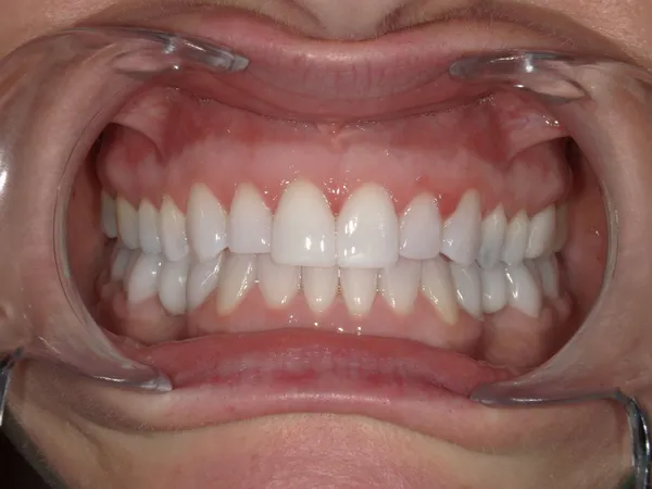 After - Replaced lower crowns with metal free dental crowns and direct veneers on upper central teeth