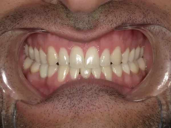 After - teeth whitening and lower bonding to close the spacing