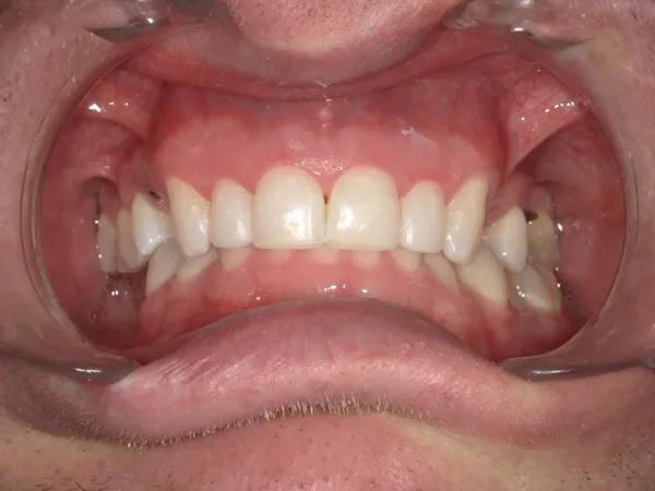After - Peg laterals restored to a more normal appearance with composite dental veneers in draper