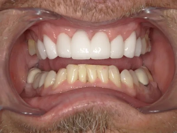 After - Upper dental veneers and a bridge to replace a missing tooth