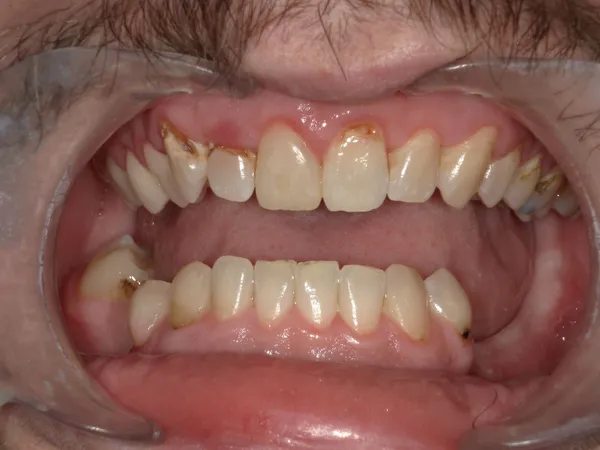 Before - Cavities filled on upper gumline