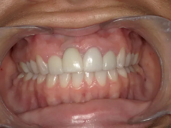 Before - Improper implant positioning created a long tooth. Remaking the dental implant crown with pink porcelain gave a more acceptable smile