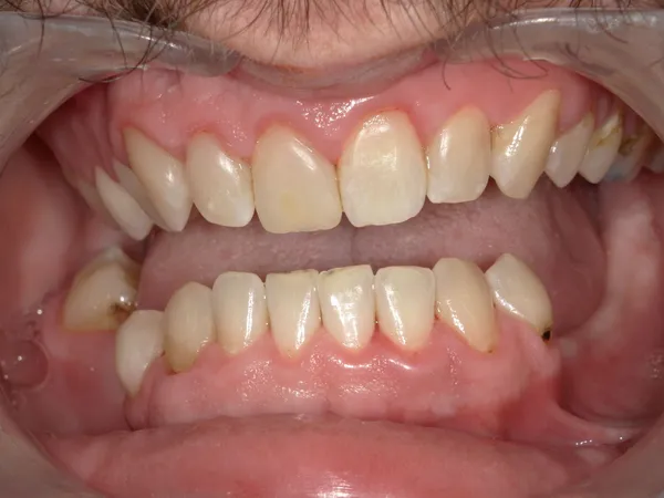 After - Cavities filled on upper gumline