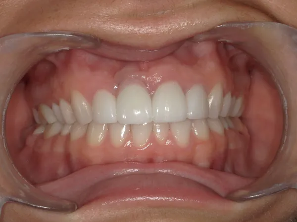 After - Improper implant positioning corrected by remaking the dental implant crown with pink porcelain