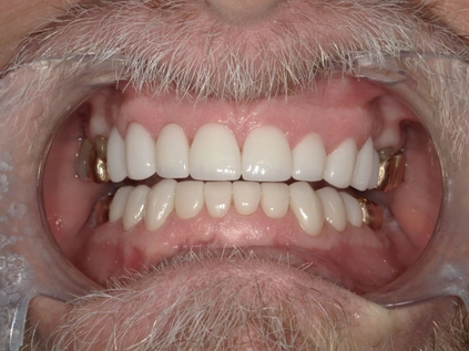 After - Heavy chips and worn teeth from grinding restored with crowns.