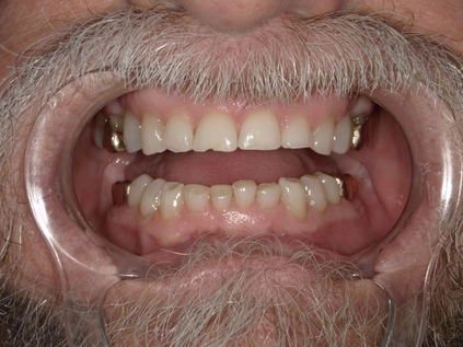 Before - Heavy chips and worn teeth from grinding restored with crowns.