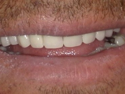 After - Upper and Lower removable partial dentures made for superior function andaesthetics.