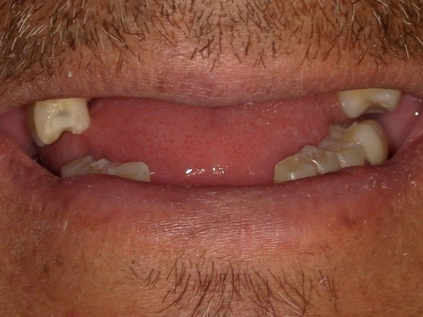 Before - Upper and Lower removable partial dentures made for superior function andaesthetics.