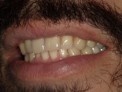 After -An upper left premolar implant was placed to replace the missing tooth andfill the space in the patient's smile.