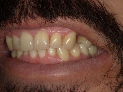 Before - An upper left premolar implant was placed to replace the missing tooth andfill the space in the patient's smile.